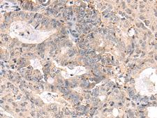 MEDAG Antibody - Immunohistochemistry of paraffin-embedded Human ovarian cancer tissue  using MEDAG Polyclonal Antibody at dilution of 1:75(×200)