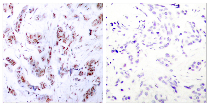 MEF2A / MEF2 Antibody - Immunohistochemistry analysis of paraffin-embedded human breast carcinoma tissue, using MEF2A Antibody. The picture on the right is blocked with the synthesized peptide.