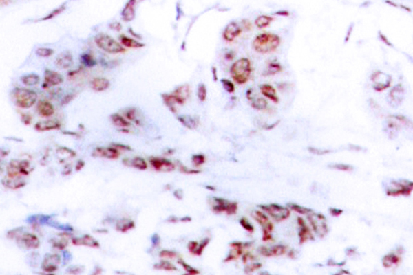 MEF2A / MEF2 Antibody - IHC of MEF2A (A306) pAb in paraffin-embedded human breast carcinoma tissue.