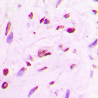 MEF2A / MEF2 Antibody - Immunohistochemical analysis of MEF2A staining in human lung cancer formalin fixed paraffin embedded tissue section. The section was pre-treated using heat mediated antigen retrieval with sodium citrate buffer (pH 6.0). The section was then incubated with the antibody at room temperature and detected using an HRP conjugated compact polymer system. DAB was used as the chromogen. The section was then counterstained with hematoxylin and mounted with DPX.