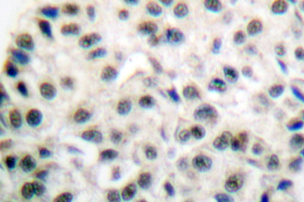 MEF2A / MEF2 Antibody - IHC of MEF2A (I402) pAb in paraffin-embedded human breast carcinoma tissue.