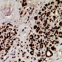 MEF2A / MEF2 Antibody - Immunohistochemical analysis of MEF2A (pS408) staining in human breast cancer formalin fixed paraffin embedded tissue section. The section was pre-treated using heat mediated antigen retrieval with sodium citrate buffer (pH 6.0). The section was then incubated with the antibody at room temperature and detected using an HRP conjugated compact polymer system. DAB was used as the chromogen. The section was then counterstained with haematoxylin and mounted with DPX.