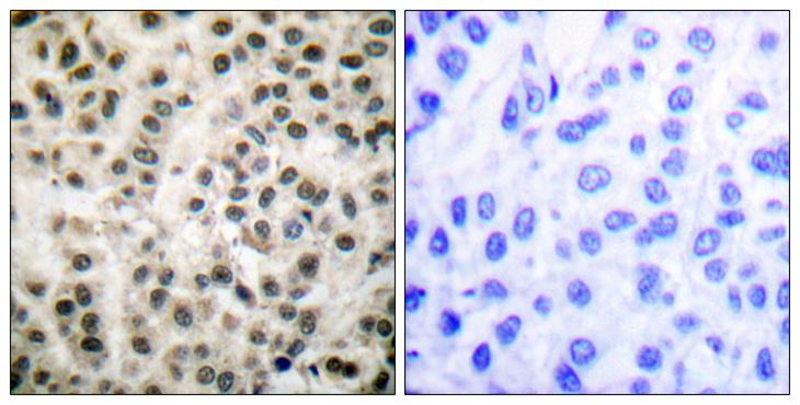MEF2A / MEF2 Antibody - Peptide - + Immunohistochemical analysis of paraffin-embedded human breast carcinoma tissue using MEF2A (Ab-408) antibody.