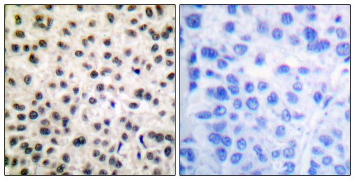 MEF2A / MEF2 Antibody - Immunohistochemistry analysis of paraffin-embedded human breast carcinoma, using MEF2A (Phospho-Ser408) Antibody. The picture on the right is blocked with the phospho peptide.