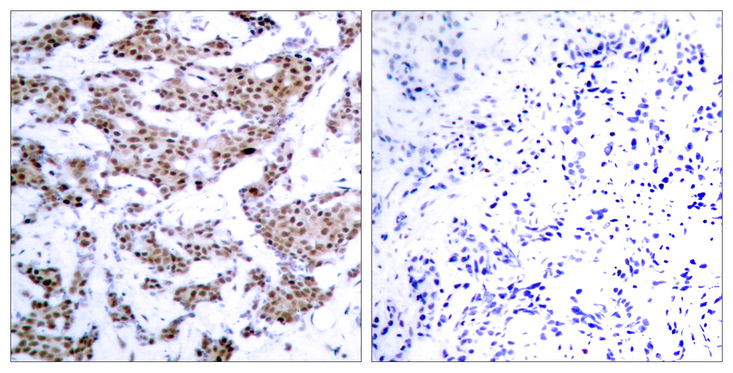 MEF2A / MEF2 Antibody - Immunohistochemistry analysis of paraffin-embedded human breast carcinoma, using MEF2A (Phospho-Thr312) Antibody. The picture on the right is blocked with the phospho peptide.
