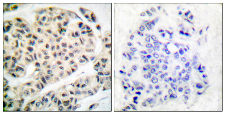 MEF2A / MEF2 Antibody - Immunohistochemistry analysis of paraffin-embedded human breast carcinoma, using MEF2A (Phospho-Thr319) Antibody. The picture on the right is blocked with the phospho peptide.