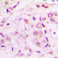 MEF2A / MEF2 Antibody - Immunohistochemical analysis of MEF2A (pT319) staining in human lung cancer formalin fixed paraffin embedded tissue section. The section was pre-treated using heat mediated antigen retrieval with sodium citrate buffer (pH 6.0). The section was then incubated with the antibody at room temperature and detected using an HRP conjugated compact polymer system. DAB was used as the chromogen. The section was then counterstained with hematoxylin and mounted with DPX.