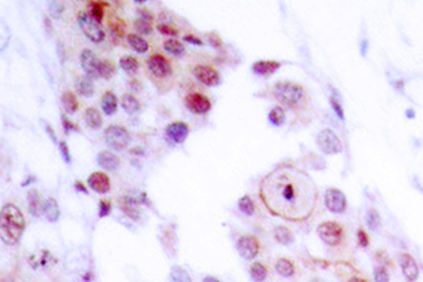 MEF2A / MEF2 Antibody - IHC of MEF2A (P313) pAb in paraffin-embedded human breast carcinoma tissue.