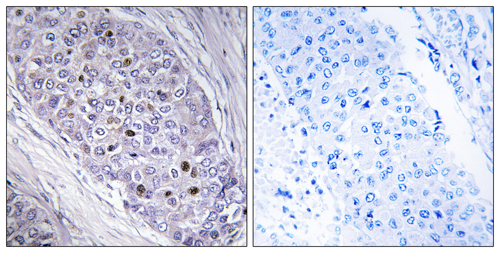 MEF2C Antibody - Immunohistochemistry analysis of paraffin-embedded human breast carcinoma tissue, using MEF2C Antibody. The picture on the right is blocked with the synthesized peptide.