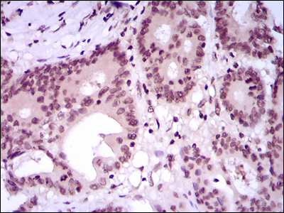 MEF2C Antibody - IHC of paraffin-embedded colon cancer tissues using MEF2C mouse monoclonal antibody with DAB staining.