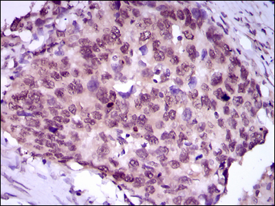 MEF2C Antibody - IHC of paraffin-embedded esophageal cancer tissues using MEF2C mouse monoclonal antibody with DAB staining.