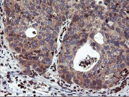 MEF2C Antibody - IHC of paraffin-embedded Carcinoma of Human lung tissue using anti-MEF2C mouse monoclonal antibody.