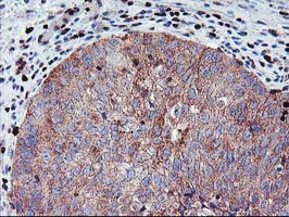 MEF2C Antibody - IHC of paraffin-embedded Carcinoma of Human bladder tissue using anti-MEF2C mouse monoclonal antibody.