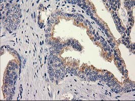 MEF2C Antibody - IHC of paraffin-embedded Carcinoma of Human prostate tissue using anti-MEF2C mouse monoclonal antibody. (Heat-induced epitope retrieval by 10mM citric buffer, pH6.0, 100C for 10min).