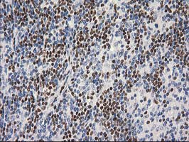 MEF2C Antibody - IHC of paraffin-embedded Human lymphoma tissue using anti-MEF2C mouse monoclonal antibody. (Heat-induced epitope retrieval by 10mM citric buffer, pH6.0, 100C for 10min).