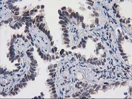 MEF2C Antibody - IHC of paraffin-embedded Carcinoma of Human lung tissue using anti-MEF2C mouse monoclonal antibody.