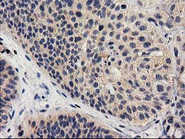 MEF2C Antibody - IHC of paraffin-embedded Carcinoma of Human bladder tissue using anti-MEF2C mouse monoclonal antibody.