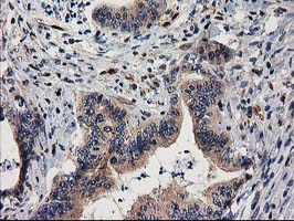 MEF2C Antibody - IHC of paraffin-embedded Adenocarcinoma of Human colon tissue using anti-MEF2C mouse monoclonal antibody.
