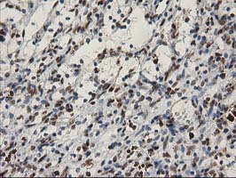 MEF2C Antibody - IHC of paraffin-embedded Carcinoma of Human kidney tissue using anti-MEF2C mouse monoclonal antibody.