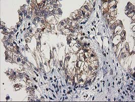 MEF2C Antibody - IHC of paraffin-embedded Adenocarcinoma of Human ovary tissue using anti-MEF2C mouse monoclonal antibody.