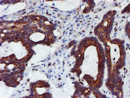 MEF2C Antibody - IHC of paraffin-embedded Adenocarcinoma of Human colon tissue using anti-MEF2C mouse monoclonal antibody. (Heat-induced epitope retrieval by 10mM citric buffer, pH6.0, 100C for 10min).