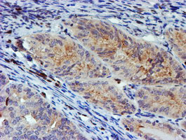 MEF2C Antibody - IHC of paraffin-embedded Adenocarcinoma of Human endometrium tissue using anti-MEF2C mouse monoclonal antibody. (Heat-induced epitope retrieval by 10mM citric buffer, pH6.0, 100C for 10min).