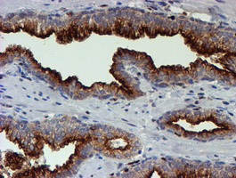 MEF2C Antibody - IHC of paraffin-embedded Carcinoma of Human prostate tissue using anti-MEF2C mouse monoclonal antibody. (Heat-induced epitope retrieval by 10mM citric buffer, pH6.0, 100C for 10min).