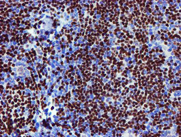 MEF2C Antibody - IHC of paraffin-embedded Human lymphoma tissue using anti-MEF2C mouse monoclonal antibody. (Heat-induced epitope retrieval by 10mM citric buffer, pH6.0, 100C for 10min).