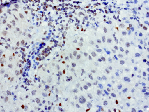 MEF2C Antibody - Immunohistochemical staining of paraffin-embedded human melanoma using anti-MEFC2 clone UMAB17 mouse monoclonal antibody at 1:200 with Polink2 Broad HRP DAB detection kit ; heat-induced epitope retrieval with citrate buffer, pH6.0 at 95-100C. Nuclear staining seen in the infiltrating lymphocyte and weak staining in tumor cells.