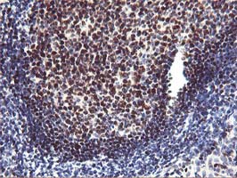 MEF2C Antibody - Immunohistochemical staining of paraffin-embedded Human lymphoma tissue using anti-MEF2C mouse monoclonal antibody. (Clone UMAB17; heat-induced epitope retrieval by 10mM citric buffer, pH6.0, 120C for 3min)