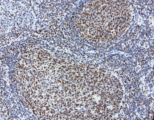 MEF2C Antibody - Immunohistochemical staining of paraffin-embedded human tonsil using anti-MEFC2 clone UMAB17 mouse monoclonal antibody at 1:200 with Polink2 Broad HRP DAB detection kit ; heat-induced epitope retrieval with citrate buffer, pH6.0 at 95-100C. Nuclear staining seen in both the germinal and non germinal centers of the the tonsil