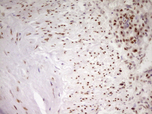MEF2D Antibody - Immunohistochemical staining of paraffin-embedded Adenocarcinoma of Human colon tissue using anti-MEF2D mouse monoclonal antibody. (Heat-induced epitope retrieval by 1 mM EDTA in 10mM Tris, pH8.5, 120C for 3min,
