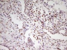 MEF2D Antibody - Immunohistochemical staining of paraffin-embedded Carcinoma of Human lung tissue using anti-MEF2D mouse monoclonal antibody. (Heat-induced epitope retrieval by 1 mM EDTA in 10mM Tris, pH8.5, 120C for 3min,