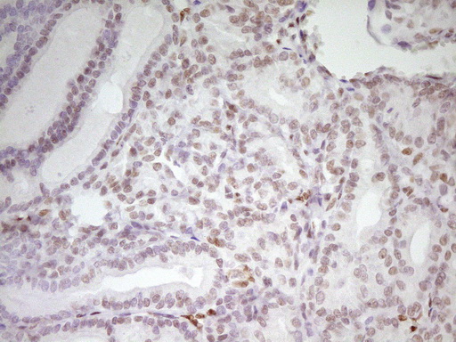 MEF2D Antibody - Immunohistochemical staining of paraffin-embedded Carcinoma of Human thyroid tissue using anti-MEF2D mouse monoclonal antibody. (Heat-induced epitope retrieval by 1 mM EDTA in 10mM Tris, pH8.5, 120C for 3min,