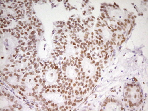 MEF2D Antibody - Immunohistochemical staining of paraffin-embedded Adenocarcinoma of Human breast tissue using anti-MEF2D mouse monoclonal antibody. (Heat-induced epitope retrieval by 1 mM EDTA in 10mM Tris, pH8.5, 120C for 3min,