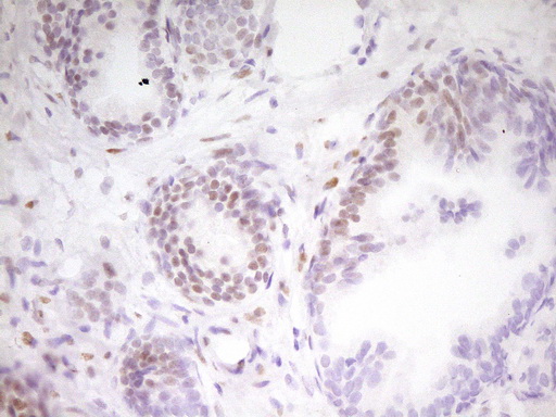 MEF2D Antibody - Immunohistochemical staining of paraffin-embedded Carcinoma of Human prostate tissue using anti-MEF2D mouse monoclonal antibody. (Heat-induced epitope retrieval by 1 mM EDTA in 10mM Tris, pH8.5, 120C for 3min,