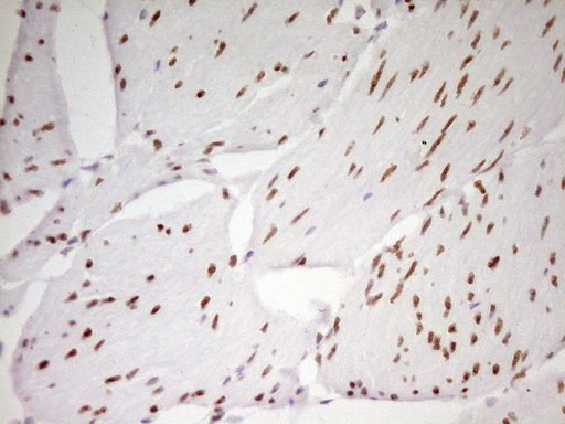 MEF2D Antibody - Immunohistochemical staining of paraffin-embedded Carcinoma of Human bladder tissue using anti-MEF2D mouse monoclonal antibody. (Heat-induced epitope retrieval by 1 mM EDTA in 10mM Tris, pH8.5, 120C for 3min,