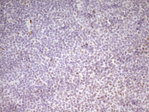 MEF2D Antibody - Immunohistochemical staining of paraffin-embedded Human lymphoma tissue using anti-MEF2D mouse monoclonal antibody. (Heat-induced epitope retrieval by 1 mM EDTA in 10mM Tris, pH8.5, 120C for 3min,