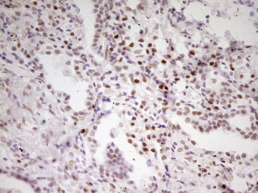 MEF2D Antibody - IHC of paraffin-embedded Carcinoma of Human lung tissue using anti-MEF2D mouse monoclonal antibody. (Heat-induced epitope retrieval by 1 mM EDTA in 10mM Tris, pH8.5, 120°C for 3min).