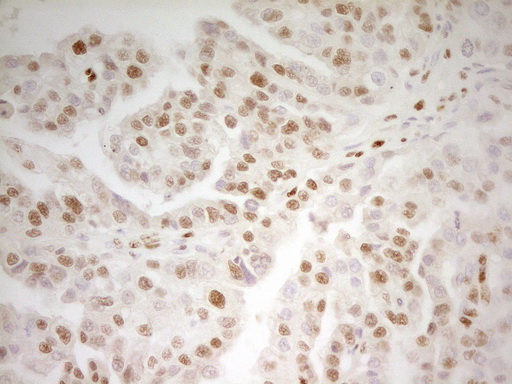 MEF2D Antibody - Immunohistochemical staining of paraffin-embedded Adenocarcinoma of Human ovary tissue using anti-MEF2D mouse monoclonal antibody. (Heat-induced epitope retrieval by 1 mM EDTA in 10mM Tris, pH8.5, 120C for 3min,