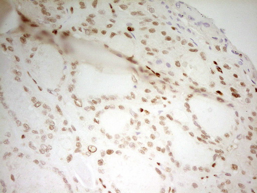 MEF2D Antibody - Immunohistochemical staining of paraffin-embedded Carcinoma of Human thyroid tissue using anti-MEF2D mouse monoclonal antibody. (Heat-induced epitope retrieval by 1 mM EDTA in 10mM Tris, pH8.5, 120C for 3min,