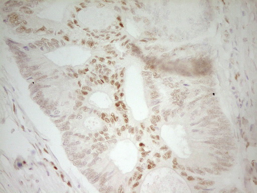 MEF2D Antibody - IHC of paraffin-embedded Adenocarcinoma of Human colon tissue using anti-MEF2D mouse monoclonal antibody. (Heat-induced epitope retrieval by 1 mM EDTA in 10mM Tris, pH8.5, 120°C for 3min).