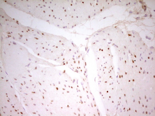 MEF2D Antibody - IHC of paraffin-embedded Carcinoma of Human bladder tissue using anti-MEF2D mouse monoclonal antibody. (Heat-induced epitope retrieval by 1 mM EDTA in 10mM Tris, pH8.5, 120°C for 3min).