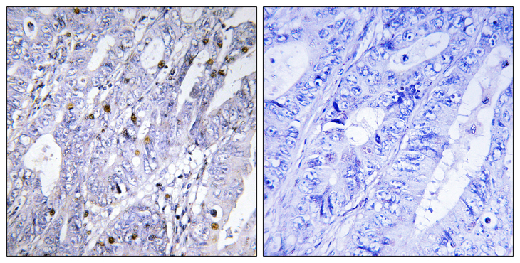 MEF2D Antibody - Immunohistochemistry analysis of paraffin-embedded human colon carcinoma tissue, using MEF2D Antibody. The picture on the right is blocked with the synthesized peptide.
