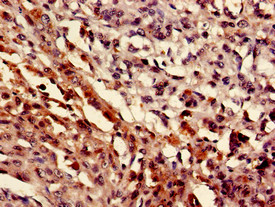 MEF2D Antibody - Immunohistochemistry of paraffin-embedded human melanoma cancer using MEF2D Antibody at dilution of 1:100