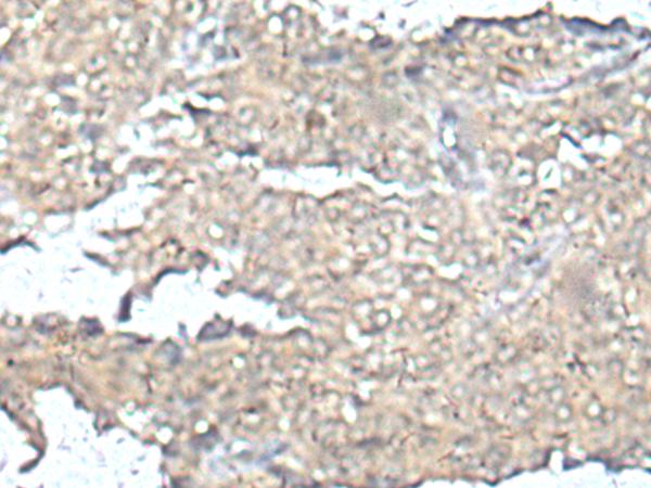MEF2D Antibody - Immunohistochemistry of paraffin-embedded Human ovarian cancer tissue  using MEF2D Polyclonal Antibody at dilution of 1:50(×200)