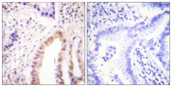 MEF2D Antibody - Immunohistochemistry analysis of paraffin-embedded human lung carcinoma, using MEF2D (Phospho-Ser444) Antibody. The picture on the right is blocked with the phospho peptide.