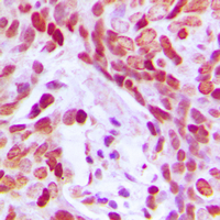 MEF2D Antibody - Immunohistochemical analysis of MEF2D (pS444) staining in human breast cancer formalin fixed paraffin embedded tissue section. The section was pre-treated using heat mediated antigen retrieval with sodium citrate buffer (pH 6.0). The section was then incubated with the antibody at room temperature and detected using an HRP conjugated compact polymer system. DAB was used as the chromogen. The section was then counterstained with hematoxylin and mounted with DPX.