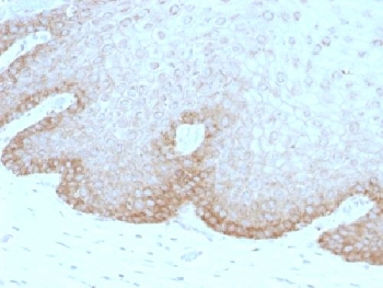 MEGF1 / FAT2 Antibody - IHC testing of human cervical carcinoma with FAT2 antibody (clone 8C5). Required HIER: boil tissue sections in 10mM citrate buffer, pH 6, for 10-20 min followed by cooling at RT for 20 min.