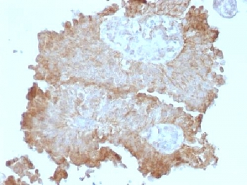 MEGF1 / FAT2 Antibody - IHC testing of human bladder carcinoma with FAT2 antibody (clone 8C5). Required HIER: boil tissue sections in 10mM citrate buffer, pH 6, for 10-20 min followed by cooling at RT for 20 min.
